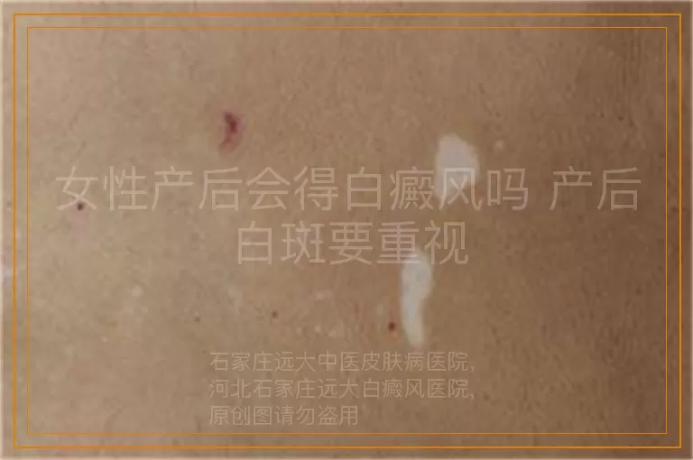 女性产后会得白癜风吗 产后白斑要重视