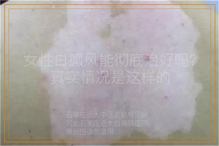 女性白癜风能彻底治好吗？真实情况是这样的
