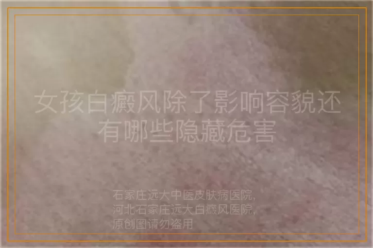 女孩白癜风除了影响容貌还有哪些隐藏危害