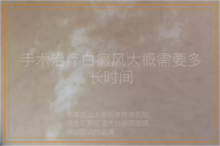 手术治疗白癜风大概需要多长时间
