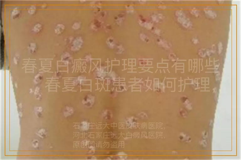 春夏白癜风护理要点有哪些，春夏白斑患者如何护理，春夏季节白癜风护理方法