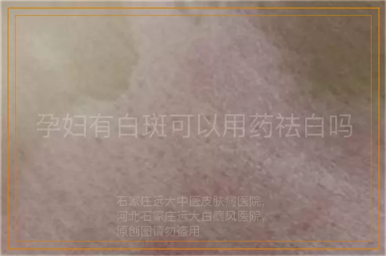 孕妇有白斑可以用药祛白吗