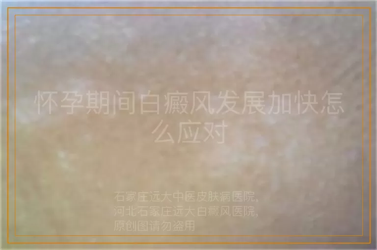 怀孕期间白癜风发展加快怎么应对
