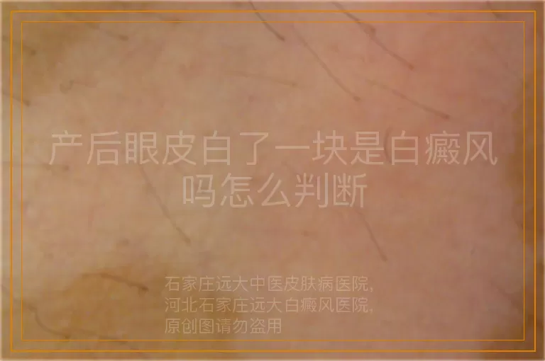 产后眼皮白了一块是白癜风吗怎么判断
