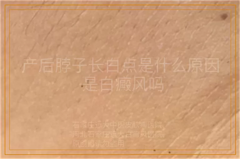 产后脖子长白点是什么原因 是白癜风吗