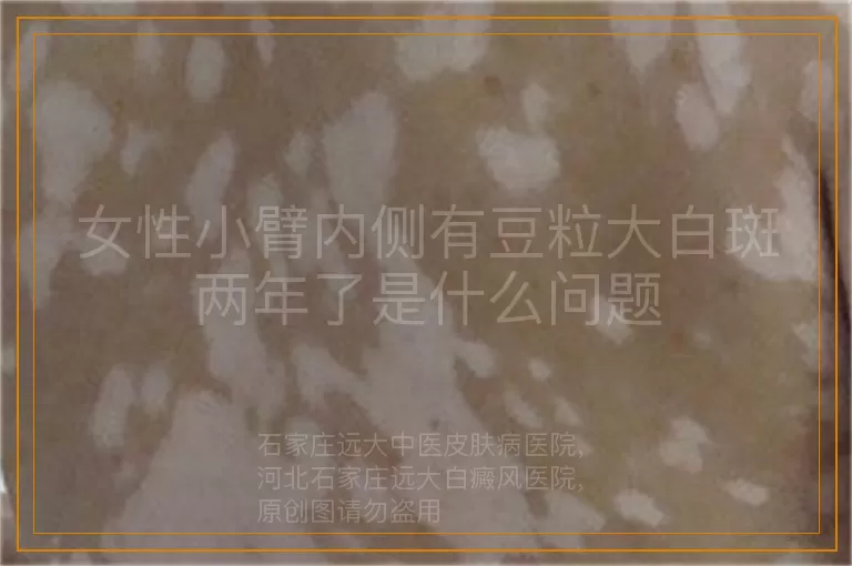 女性小臂内侧有豆粒大白斑两年了是什么问题