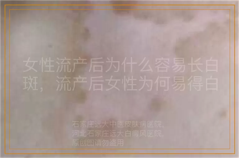 女性流产后为什么容易长白斑，流产后女性为何易得白癜风，女性流产后白斑高发原因解析
