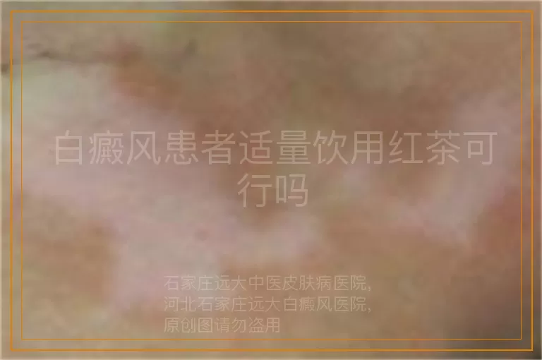 白癜风患者适量饮用红茶可行吗