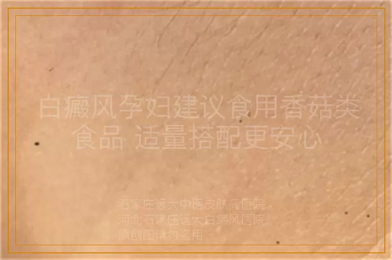 白癜风孕妇建议食用香菇类食品 适量搭配更安心