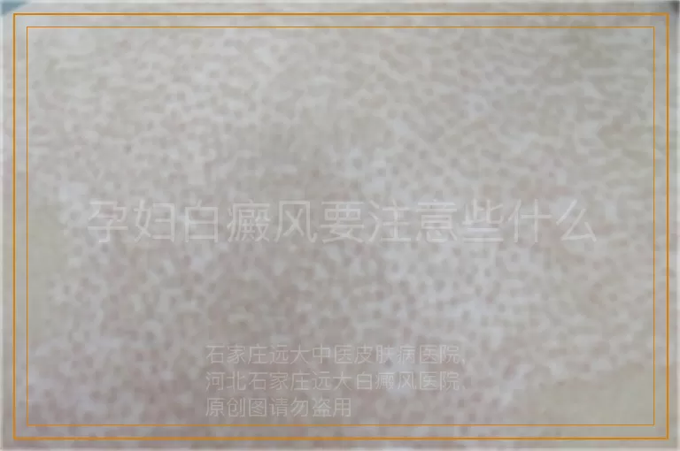 孕妇白癜风要注意些什么