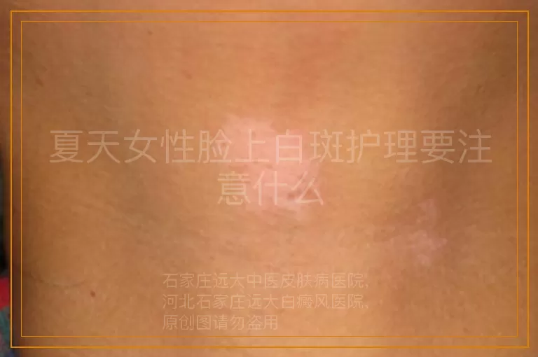 夏天女性脸上白斑护理要注意什么