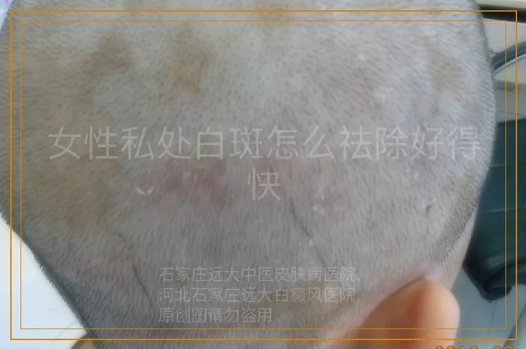 女性私处白斑怎么祛除好得快
