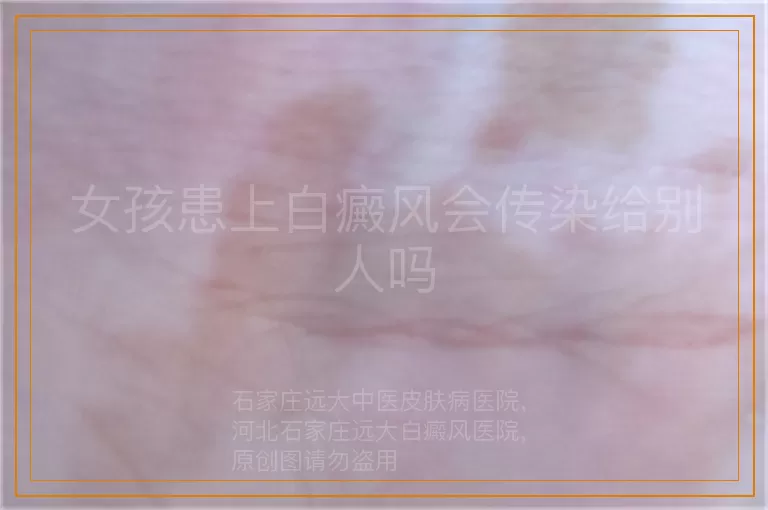 女孩患上白癜风会传染给别人吗