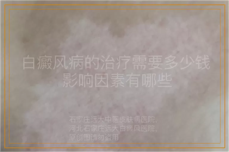 白癜风病的治疗需要多少钱 影响因素有哪些