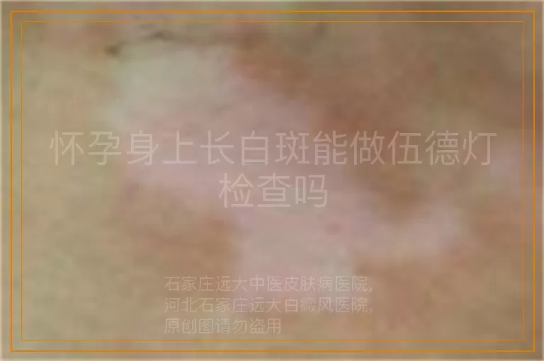 怀孕身上长白斑能做伍德灯检查吗