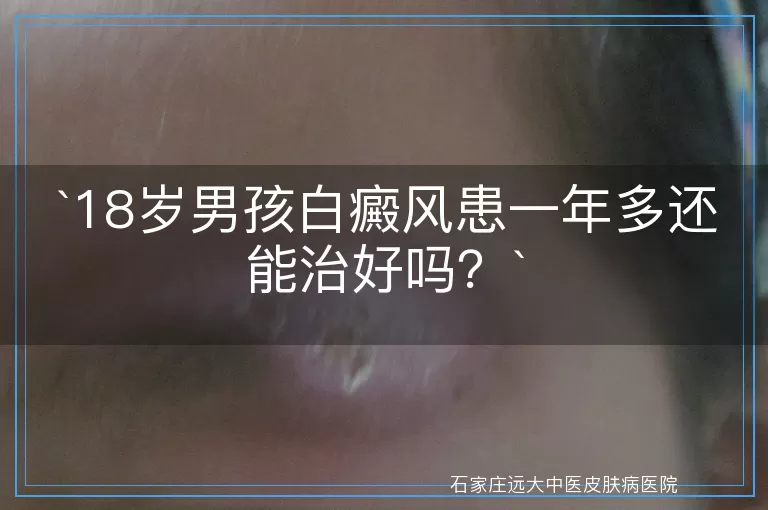 18岁男孩白癜风患一年多还能治好吗？
