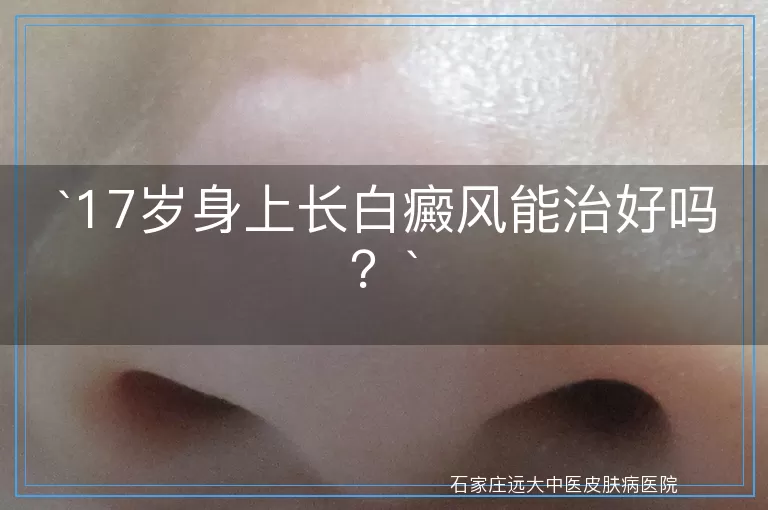 17岁身上长白癜风能治好吗？