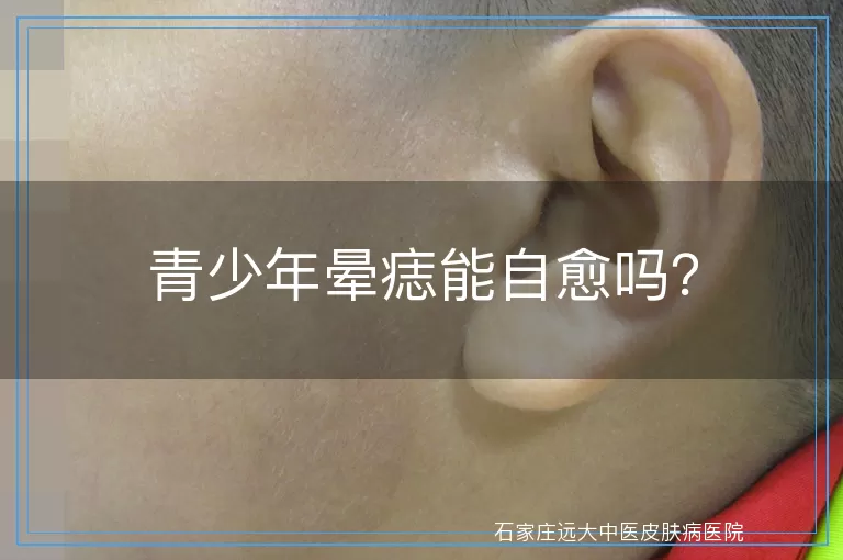 青少年晕痣能自愈吗？