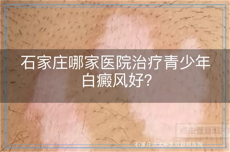 石家庄哪家医院治疗青少年白癜风好？