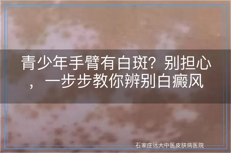 青少年手臂有白斑？别担心，一步步教你辨别白癜风