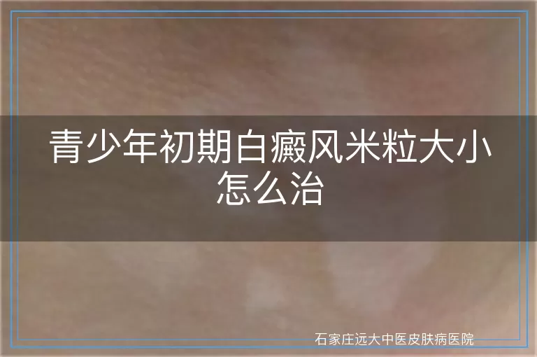 青少年初期白癜风米粒大小怎么治