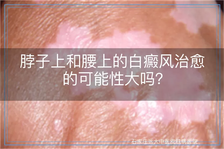 脖子上和腰上的白癜风治愈的可能性大吗？