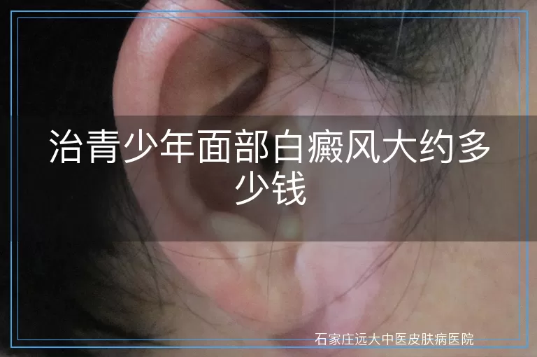 治青少年面部白癜风大约多少钱