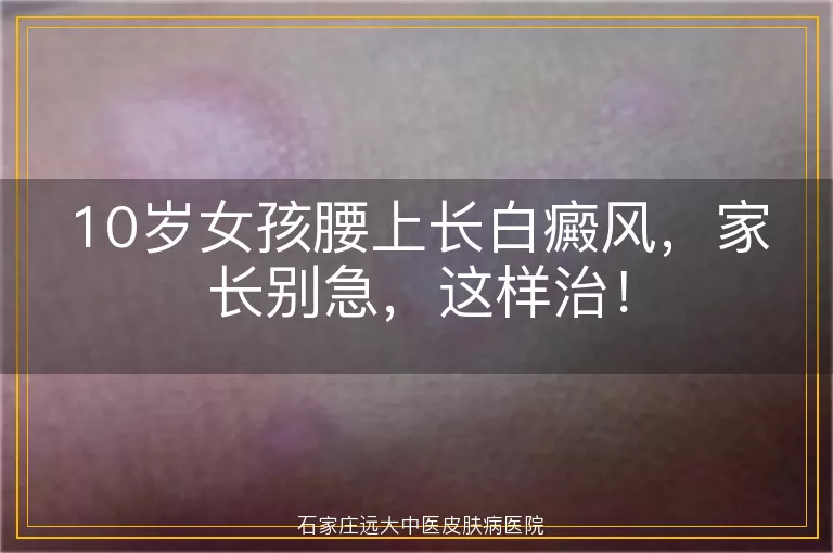 10岁女孩腰上长白癜风,家长别急,这样治!