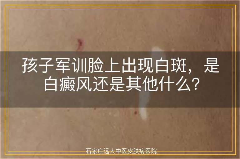 孩子军训脸上出现白斑，是白癜风还是其他什么？