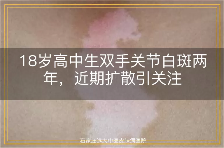 18岁高中生双手关节白斑两年，近期扩散引关注