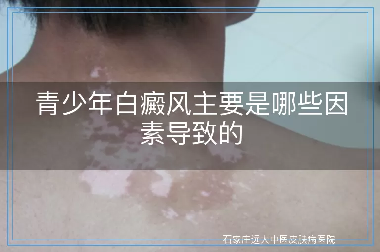 青少年白癜风主要是哪些因素导致的