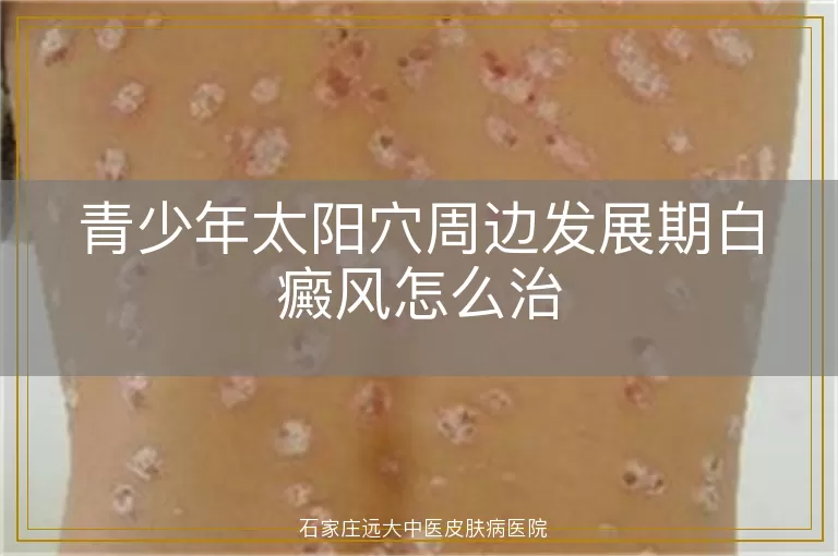 青少年太阳穴周边发展期白癜风怎么治