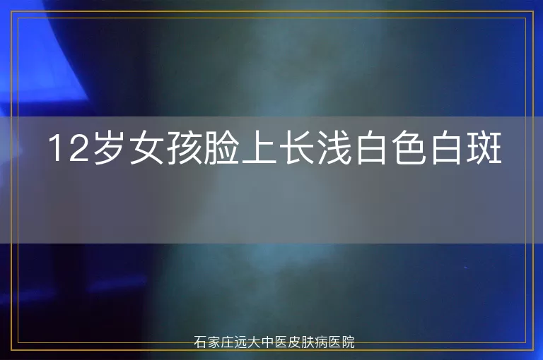 12岁女孩脸上长浅白色白斑