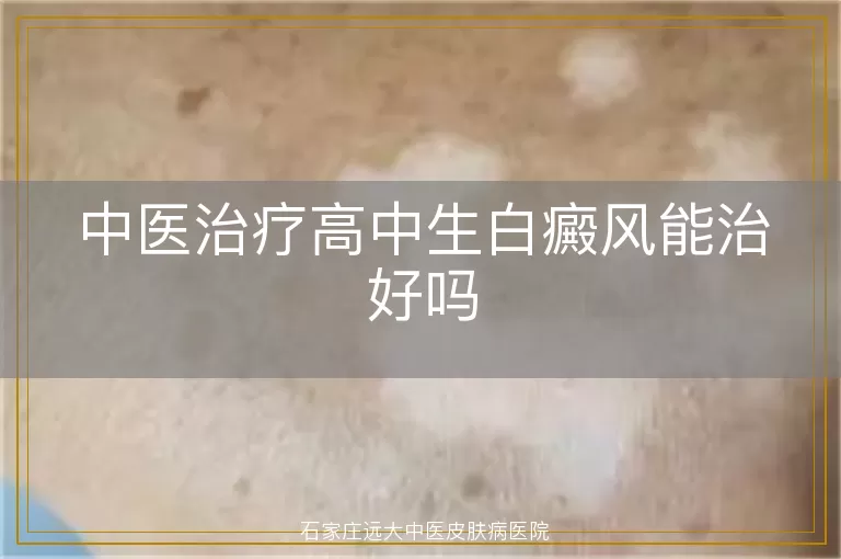 中医治疗高中生白癜风能治好吗