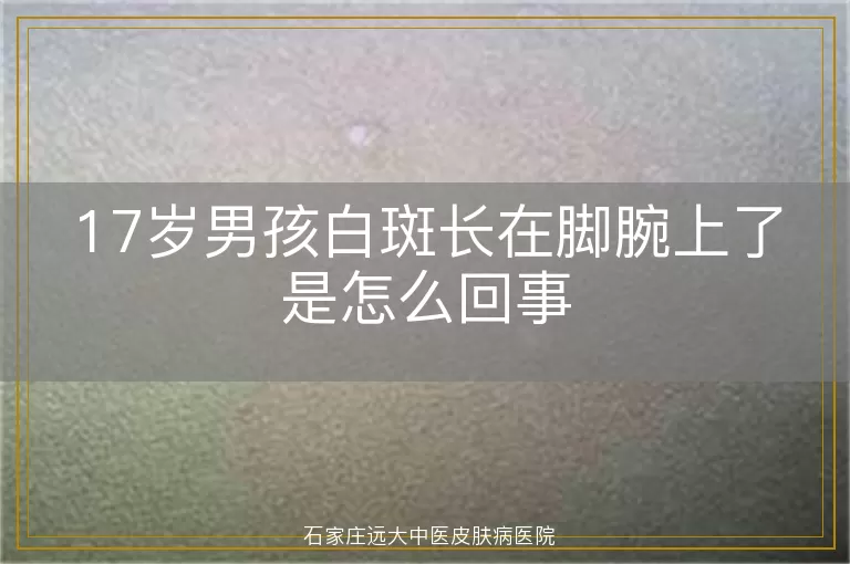 17岁男孩白斑长在脚腕上了是怎么回事