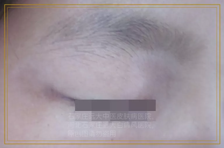 青少年后背白癜风照完紫外线灯能洗澡吗