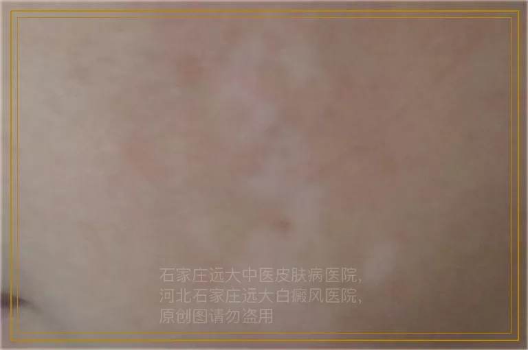 青少年肚子后背有白癜风怎么治