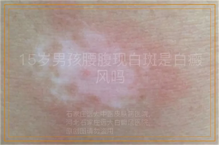 15岁男孩腰腹现白斑是白癜风吗