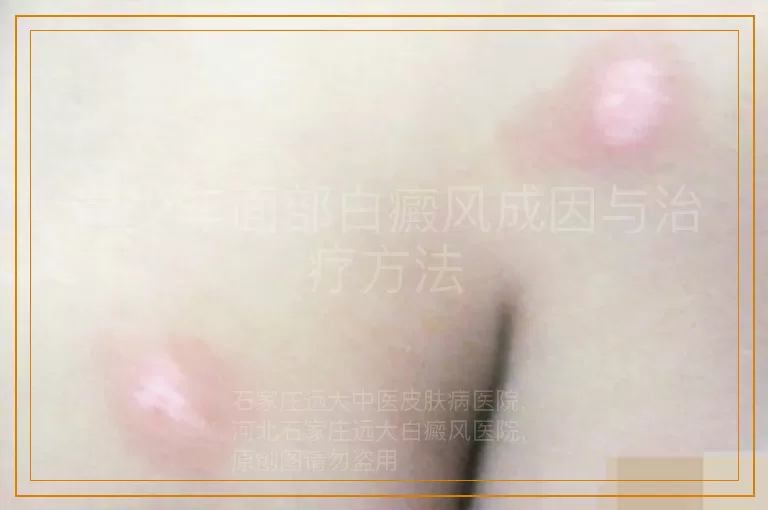 青少年面部白癜风成因与治疗方法