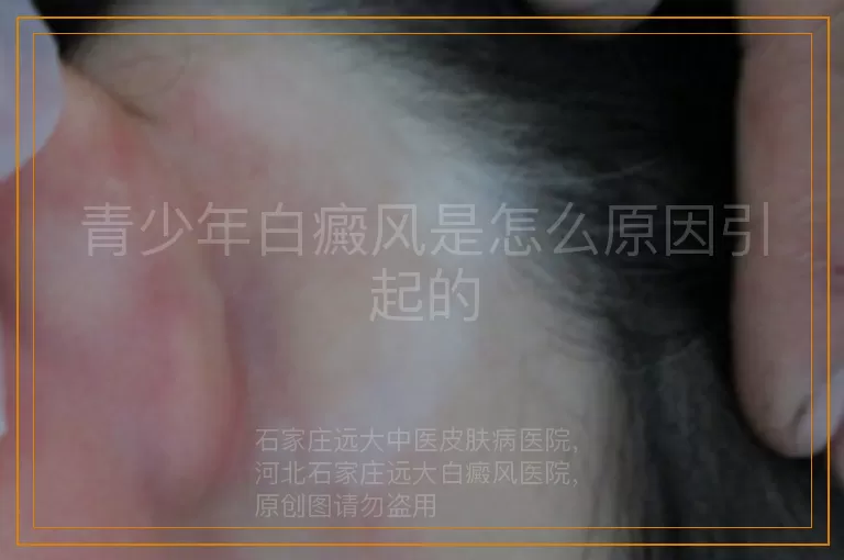 青少年白癜风是怎么原因引起的