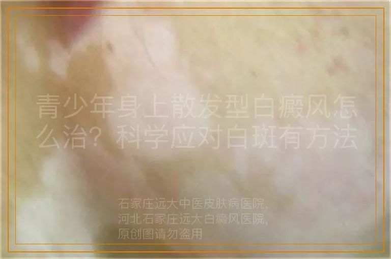 青少年身上散发型白癜风怎么治？科学应对白斑有方法