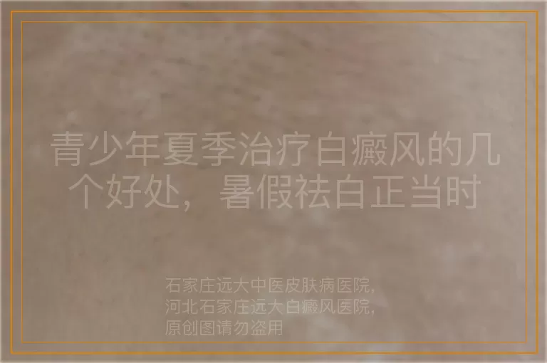 青少年夏季治疗白癜风的几个好处，暑假祛白正当时