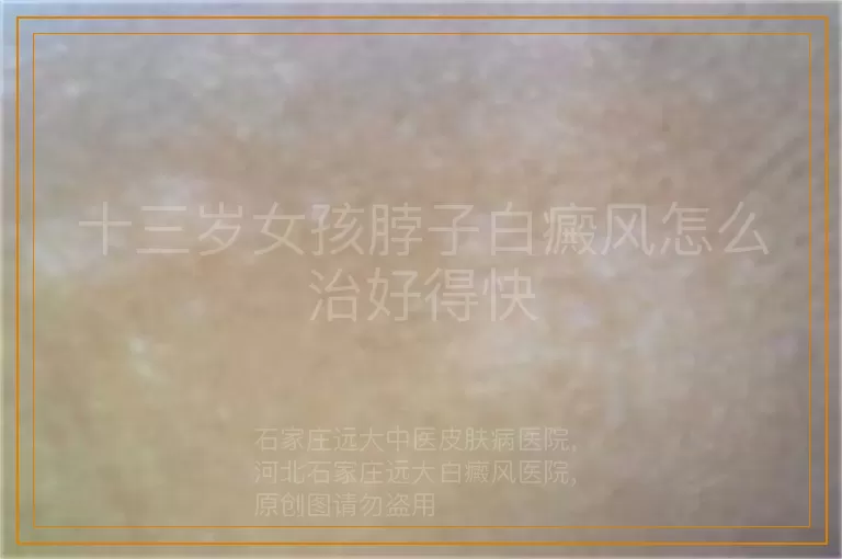 十三岁女孩脖子白癜风怎么治好得快