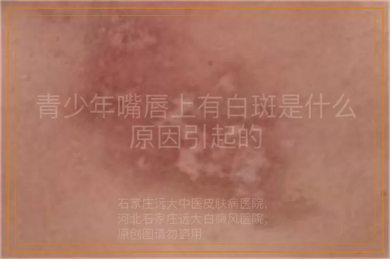 青少年嘴唇上有白斑是什么原因引起的