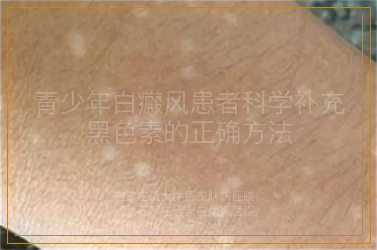 青少年白癜风患者科学补充黑色素的正确方法