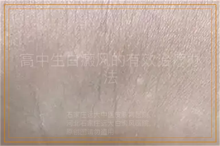 高中生白癜风的有效治疗办法