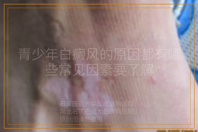 青少年白癜风的原因都有哪些常见因素要了解