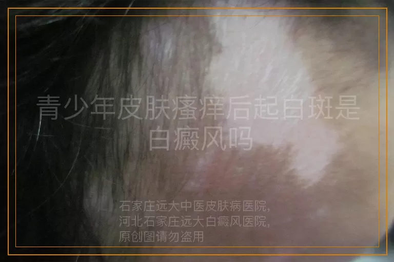 青少年皮肤瘙痒后起白斑是白癜风吗