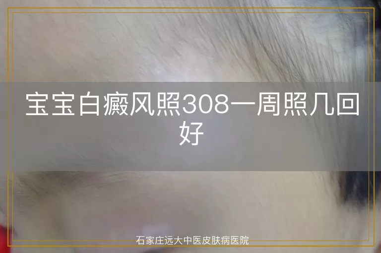 宝宝白癜风照308一周照几回好