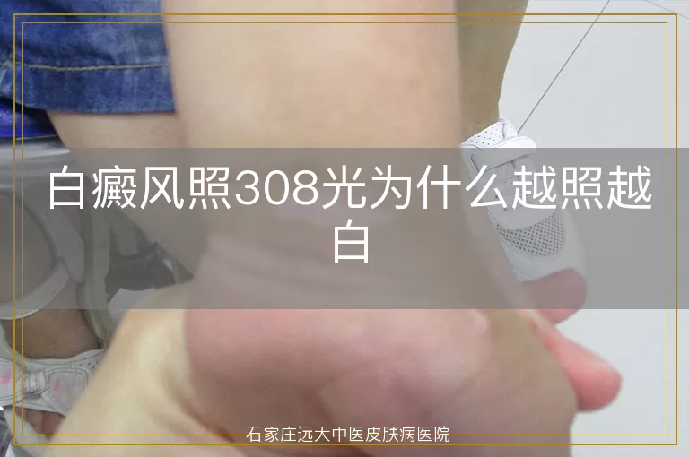 白癜风照308光为什么越照越白